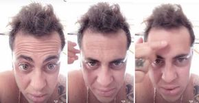 Thammy Miranda reclama da careca nas redes sociais