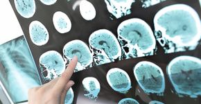 Alzheimer: exame mais acessível descobre sinais da doença mais cedo