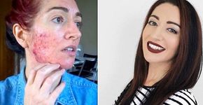 Blogueira de beleza acaba com a acne após 15 anos de tentativa
