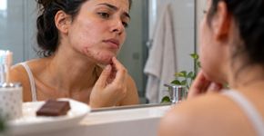 A acne que surge depois dos 25 anos pode não ter relação direta com o chocolate, mas com alterações hormonais e resistência à insulina que favorecem a produção de sebo