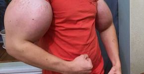 Homem que injetou óleo nos braços pode ter que amputá-los