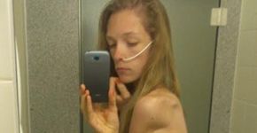 Ela chegou a pesar só 30kg e hoje faz campanha contra anorexia