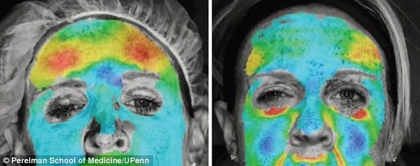 Antes aplicação botox