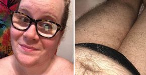 Jovem mostra efeitos de distúrbio hormonal pelo corpo
