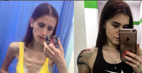 Jovem vence anorexia e vira instrutora física. ‘Antes e Depois’