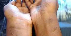 Tatuadora cobre nome de ex e cicatrizes com 50% de desconto