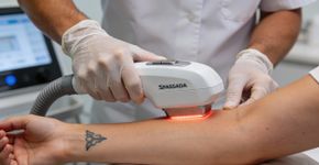 Quanto custa remover uma tatuagem pequena com laser?