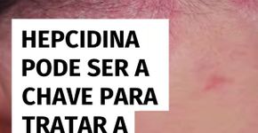 Hepcidina pode ser a chave para tratar a psoríase
