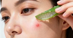 O truque simples com aloe vera que desincha espinhas em minutos