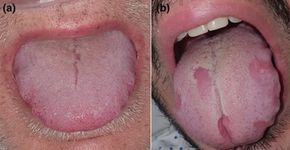 Foto: (British Journal of Dermatology)