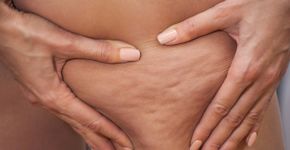 Celulite: entenda relação com demência, derrame e outra doenças