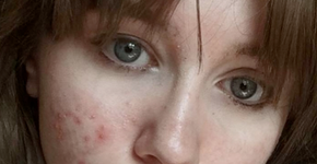 Jovem posta selfie para mostrar que é bonita mesmo com acne