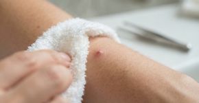 Pelo encravou? Uma toalha com água morna pode ajudar sem você precisar cavar a pele com pinça
