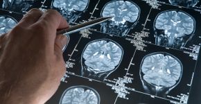 Após sentir cheiro estranho, homem descobre tumor cerebral