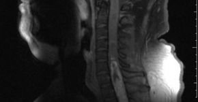 Tumor cerebral raro é descrito pela primeira vez no Brasil
