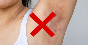 Como suavizar manchas nas axilas e virilhas sem cair em receitas que podem irritar a pele
