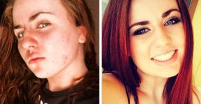 Ex-usuários usam fotos de ‘antes e depois’ na luta contra drogas