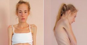 Recuperada há 6 meses, jovem compartilha fotos do período em que sofreu de anorexia