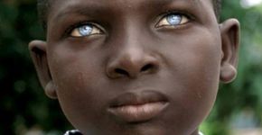 Albinismo ocular: uma condição genética que pode trazer problemas