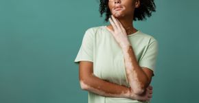 Conheça os principais sinais do vitiligo