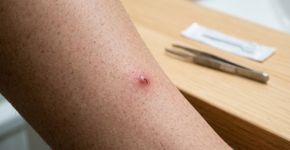Pelo encravado apareceu depois da depilação? A primeira solução não é agulha nem pinça