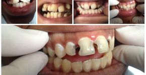 ONG seleciona jovens para oferecer tratamento dentário gratuito