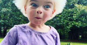 Síndrome rara faz cabelo de menino estar sempre arrepiado 