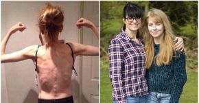 Mãe revela fotos da filha que se recupera de anorexia