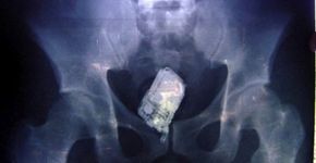 13 raios-x divulgados por médicos que vão te deixar espantado