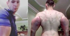 Homem injeta óleo no corpo e ganha supermúsculos a um preço alto