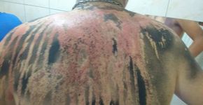 Calouros são queimados em trote com creolina e larvicida