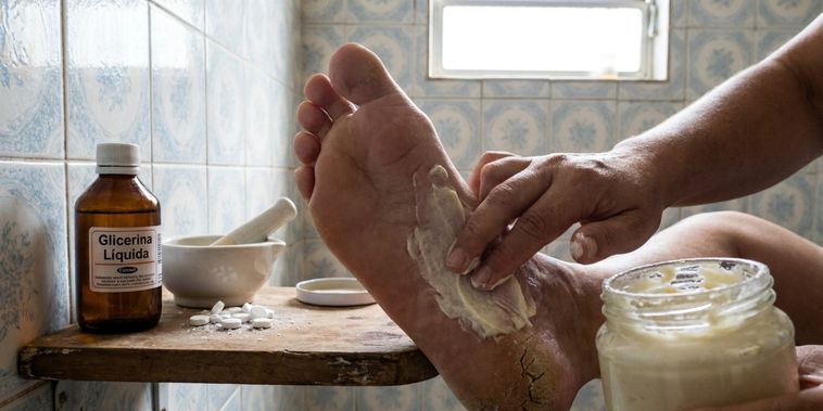 Featured main: Nem sal, nem azeite: A receita caseira que hidrata permanentemente os calcanhares rachados, proporcionando suavidade e alívio