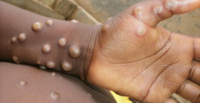Foto: (OMS/Nigeria Center for Disease Control)