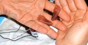 Bebês nascem com apenas 21 semanas e sobrevivem