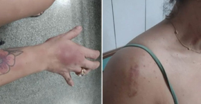 Foto: (Após flagrar a traição do marido em um restaurante, uma mulher foi espancada pelo próprio companheiro. O caso ocorreu na noite de domingo, 21, no bairro do Imbuí, em Salvador (BA). Ariele de Almeida Rocha, de 36 anos, relata que levou socos no rosto, chutes na barriga, foi enforcada e teve a mão atingida por marteladas pelo marido, Jonatha de Amorim Souza, 36. As informações são do G1. O advogado da vítima disse que Ariele foi jantar com Jonatha, que levou uma amiga. Para a companheira, o rapaz alegou que a mulher havia terminado um relacionamento recentemente e precisava sair um pouco. Em certo momento, Ariele foi ao banheiro e, quando retornou, viu Jonatha e a suposta amiga aos beijos. A vítima e o suspeito então iniciaram uma discussão, e saíram do restaurante junto com a outra mulher.  Ainda de acordo com o relato da defesa da vítima, Jonatha levou as duas para o apartamento do casal e, ao chegar lá, passou a agredir Ariele.  De acordo com informações do G1, as agressões só terminaram depois que vizinhos ouviram gritos e chamaram a Polícia Militar. Jonatha foi preso em flagrante e encaminhado à Delegacia Especial de Atendimento à Mulher (Deam).)