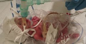 Bebê prematura sobrevive após ser enrolada em saco plástico de sanduíche