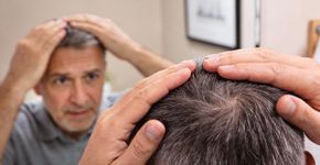 Mulheres sofrem com alopecia e não sabem a causa real