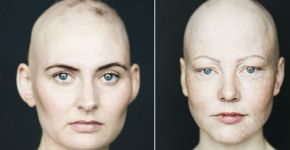 Fotógrafa captura retratos de pessoas com alopecia