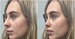 Aplicativos gratuitos simulam efeitos de cirurgia plástica