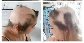 Relacionamento infeliz faz garota perder o cabelo