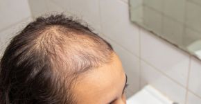 Veja se a sua queda de cabelo é normal ou um sinal de alerta urgente