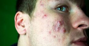 Homem revela como acabou com acne; veja antes e depois