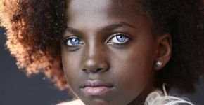 Menina com síndrome rara chama atenção pela cor dos olhos