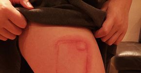 Menina fica com queimadura em formato de iPhone após reação causada por substância tóxica