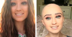 Blogueira se abre sobre a alopecia para empoderar outras pessoas