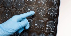 Café pode ser um aliado na prevenção do Parkinson, aponta estudo