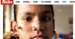 Menina pode ser 1ª mulher com ‘doença do homem-árvore’