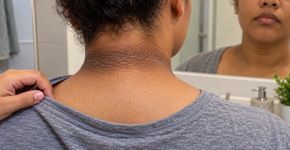 O sinal na pele que pode surgir antes do diagnóstico de diabetes tipo 2 e que muita gente confunde com uma mudança natural da idade