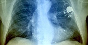 Aparelho usa energia do coração em marca-passo e pode substituir bateria