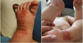 Crianças beijadas que ficam com herpes